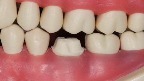 Udemy - Dental Crowns (Prep-Temp-Final)
