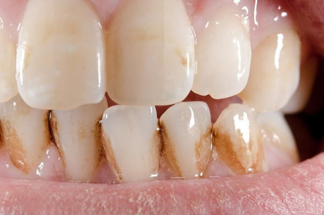 Как лечить плохие зубы