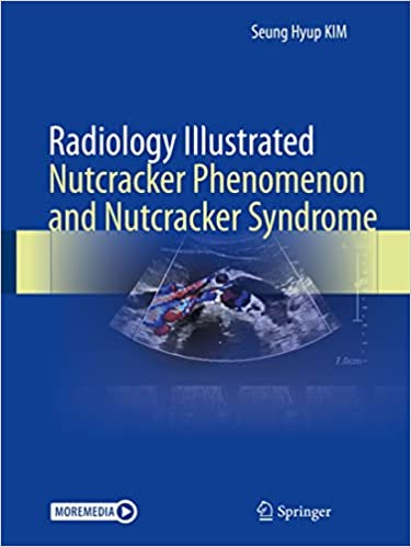 Radiology Illustrated Nutcracker Phenomenon and Nutcracker Syndrome