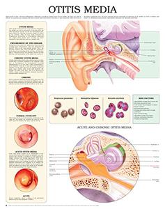 Otitis Media e chart Full illustrated