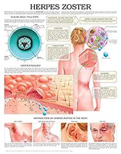 Herpes Zoster e chart Full illustrated