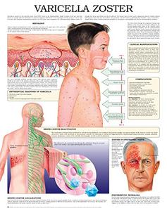 Varicella zoster e chart Full illustrated