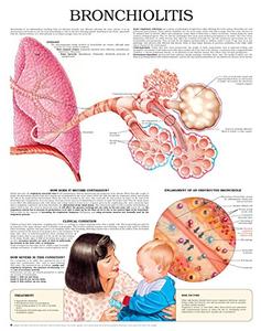 Bronchiolitis e chart Full illustrated
