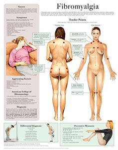 Fibromyalgia e chart Full illustrated