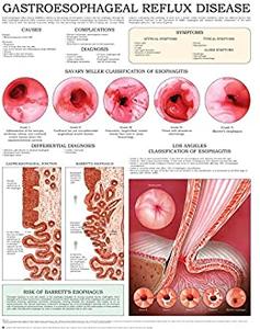 Gastroesophageal reflux disease e-chart Quick reference guide