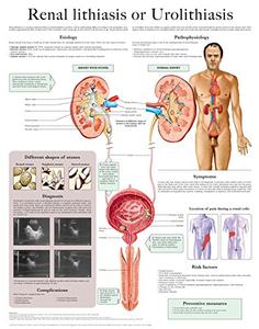 Renal lithiasis or Urolithiasis e chart Full illustrated