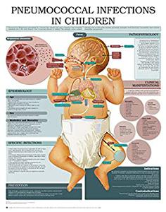 Pneumococcal infections in children e chart Full illustrated
