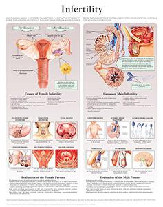 Infertility e chart Full illustrated