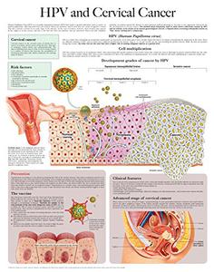 HPV and Cervical Cancer e-chart Full illustrated