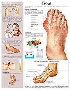Gout e-chart Full illustrated