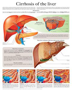 Cirrhosis of the liver e-chart Full illustrated