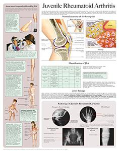 Juvenile Rheumatoid Arthritis e-chart Quick reference guide