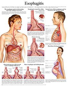 Esophagitis e-chart Full illustrated