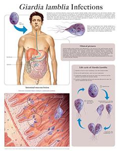 Giardia lamblia infections e-chart Full illustrated
